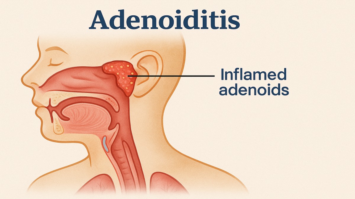 Adenoiditis: Understanding, Managing, and Treating This Common Condition 41 Adenoiditis