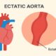 Ectatic Aorta: Causes, Risks, and Treatment Explained 60 Ectatic Aorta