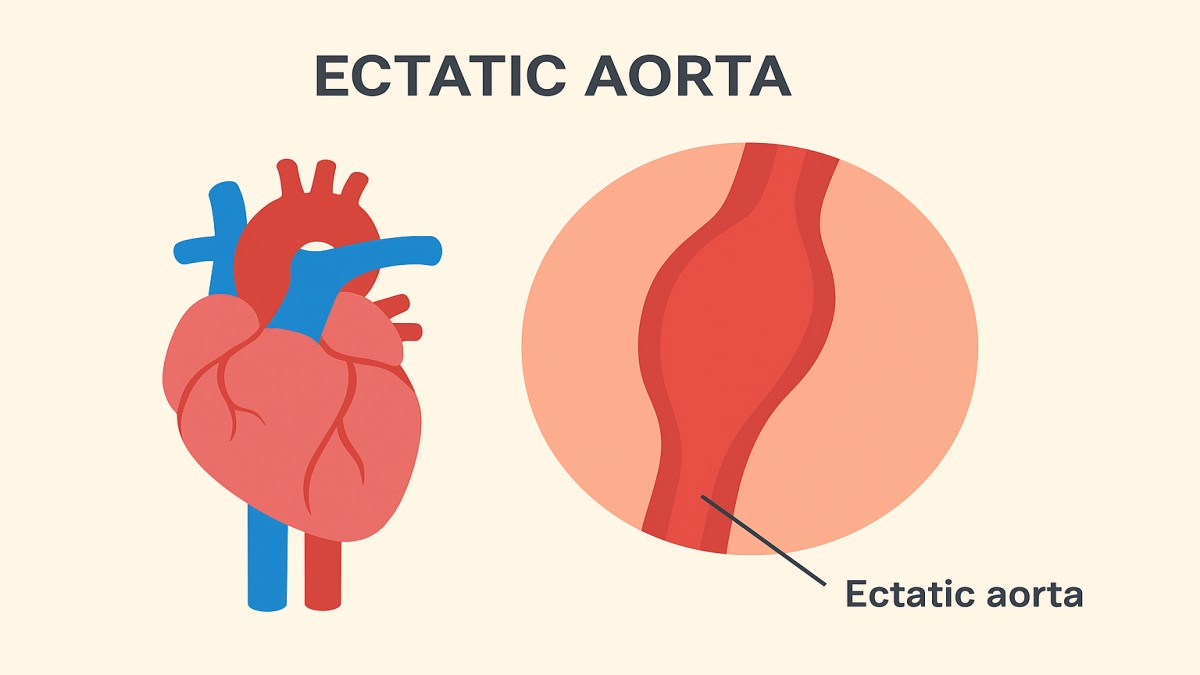 Ectatic Aorta