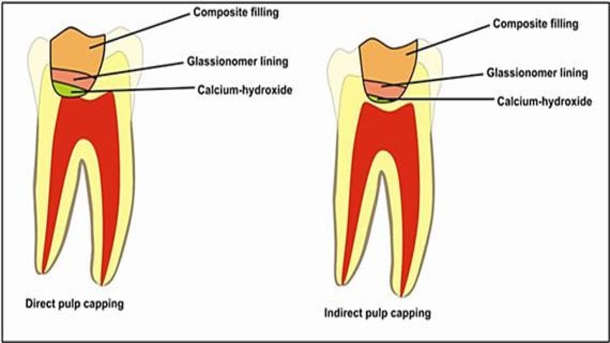 Pulp Capping