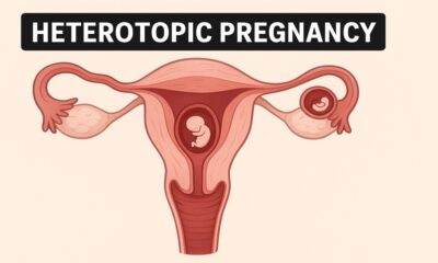 Understanding Heterotopic Pregnancy: Causes, Symptoms, and Treatment 49 Heterotopic Pregnancy