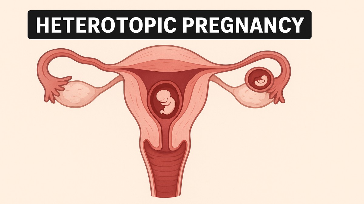 Understanding Heterotopic Pregnancy: Causes, Symptoms, and Treatment 41 Heterotopic Pregnancy