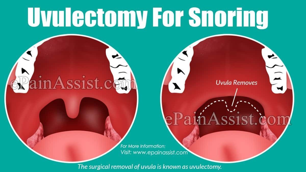 Uvulectomy: Procedure, Benefits, Risks & Complete Guide 41 Uvulectomy
