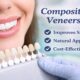 Composite Veneers
