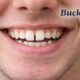 Buck Teeth